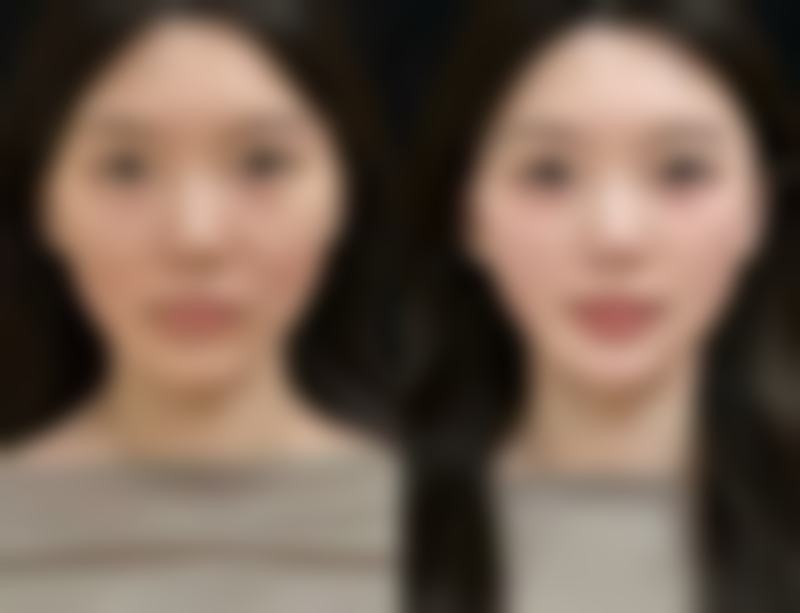 自体脂肪隆胸能做吗？原理与优势大解析