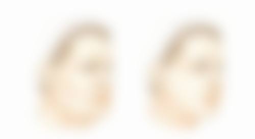 面部疤痕凹陷日常护理不可少，精心呵护成效好