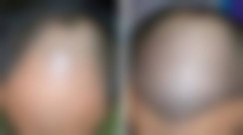 七、武汉武总华科植发专科医院价格表:(仅供参考)